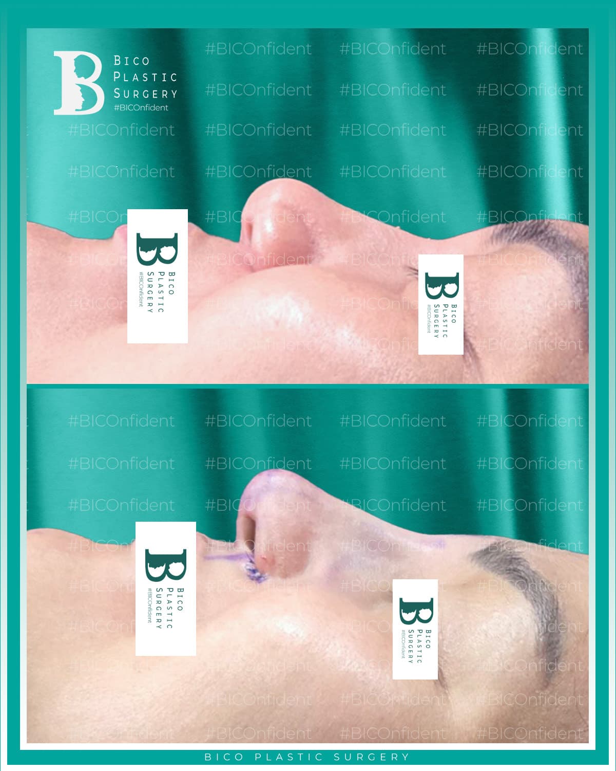 Rhinoplasty Result