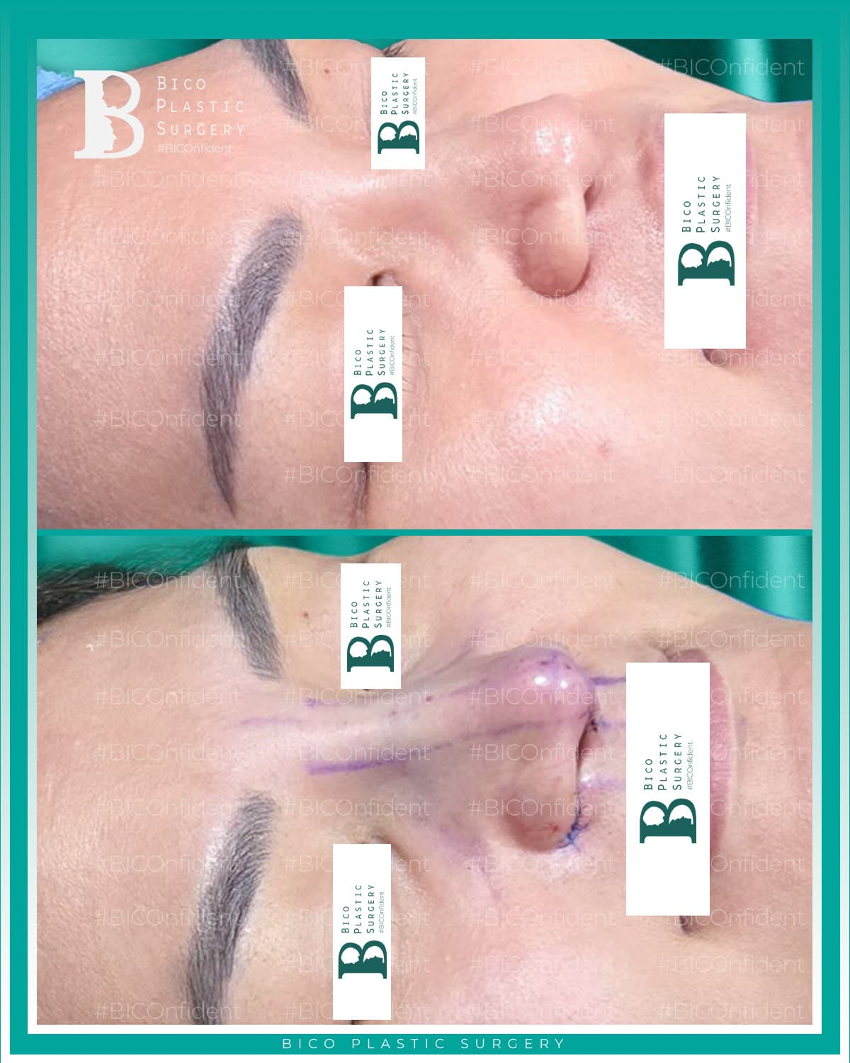 Rhinoplasty Result