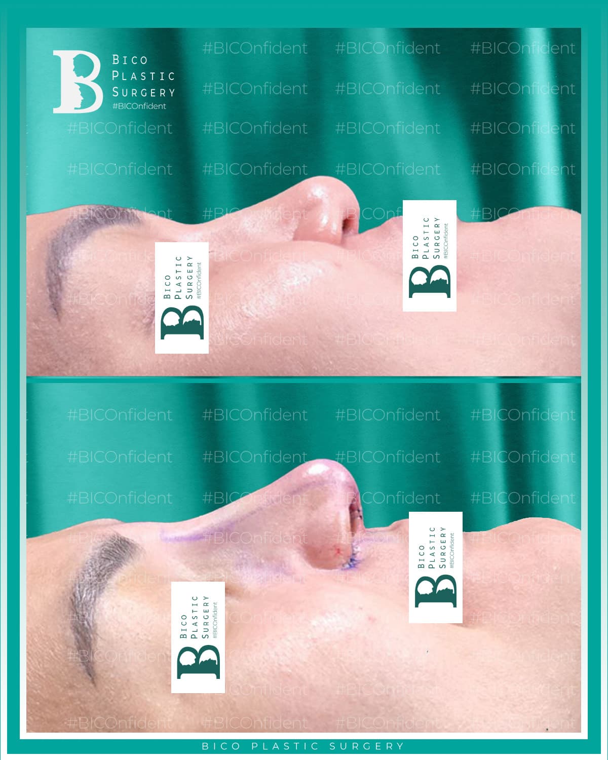 Rhinoplasty Result