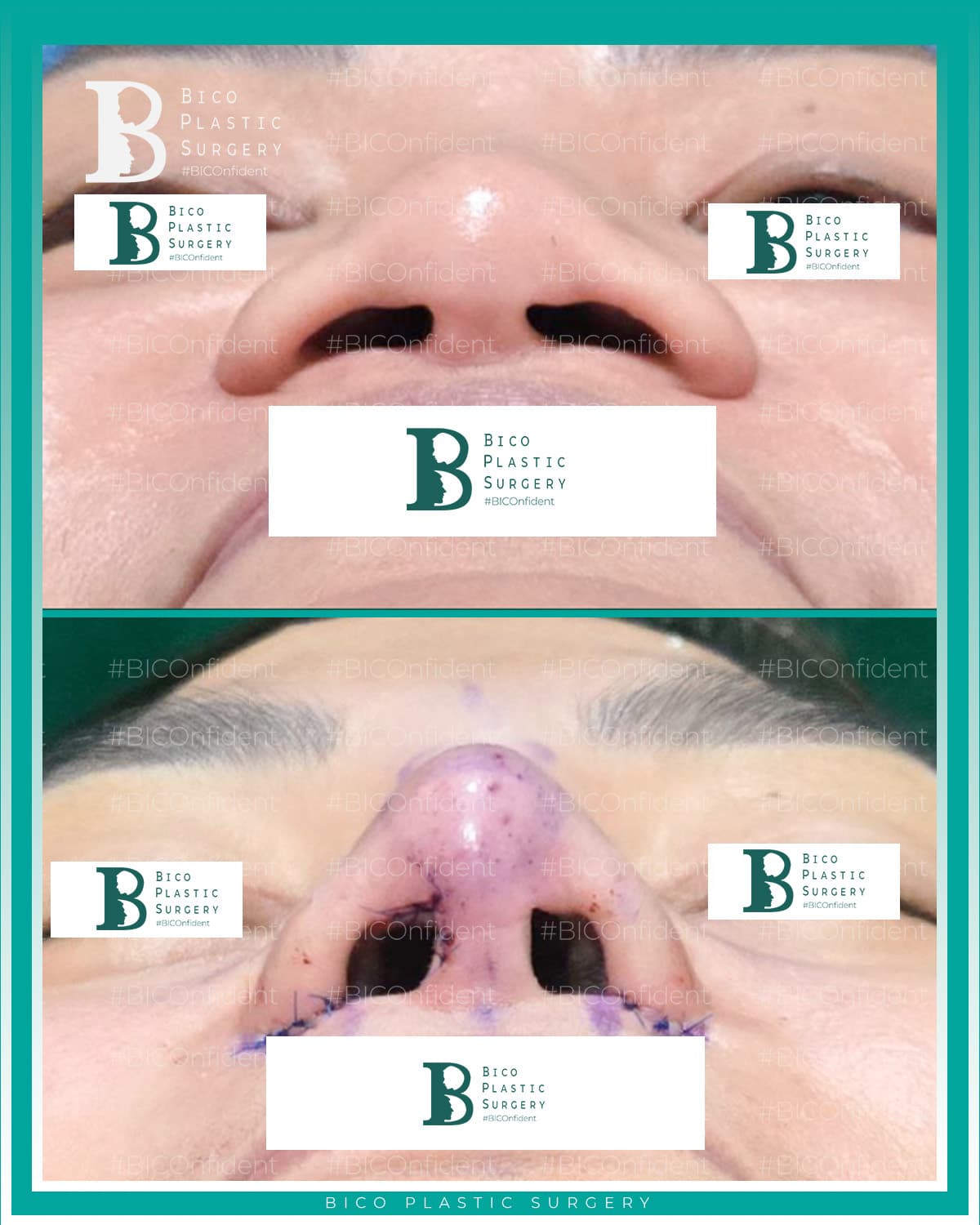 Rhinoplasty Result