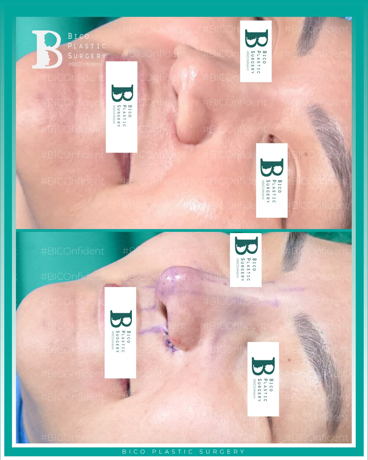 Rhinoplasty Result